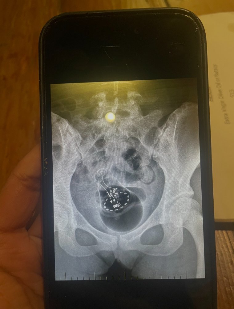 x-ray